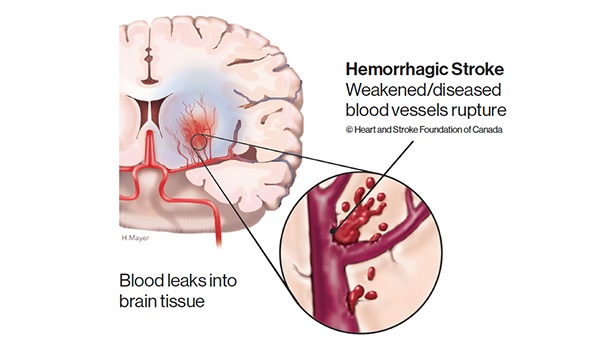 Brain with inset of ruptured blood vessels..  Label: Weakened/diseased blood vessels rupture. Blood leaks into brain tissue.  © Heart and Stroke Foundation of Canada 