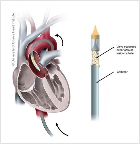 TAVI - Catheter valve in heart 