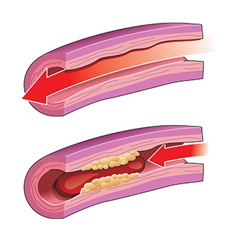 <p>Normal blood flow through healthy artery (top) and blocked blood flow in artery with yellow plaque and red blood clot (bottom).</p> <p>Normal blood flow through healthy artery (top) and blocked blood flow in artery with yellow plaque and red blood clot (bottom).</p>