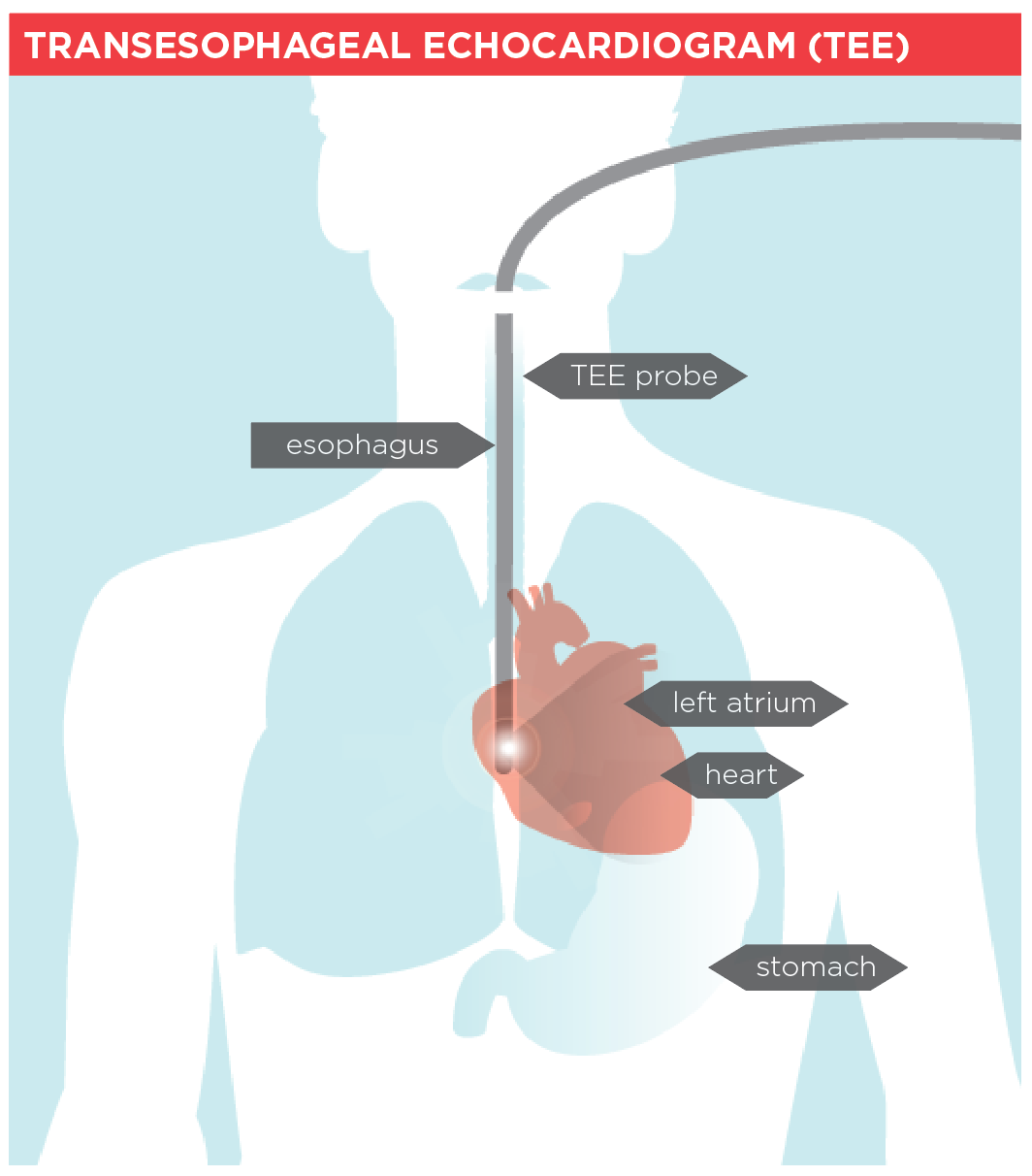 Illustration of a Transesophageal echocardiogram (TEE)