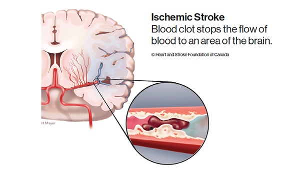 Brain with inset of a vein containing blocked  blood vessels.  Label: Blood clot stops the flow of blood to an area of the brain.  © Heart and Stroke Foundation of Canada 