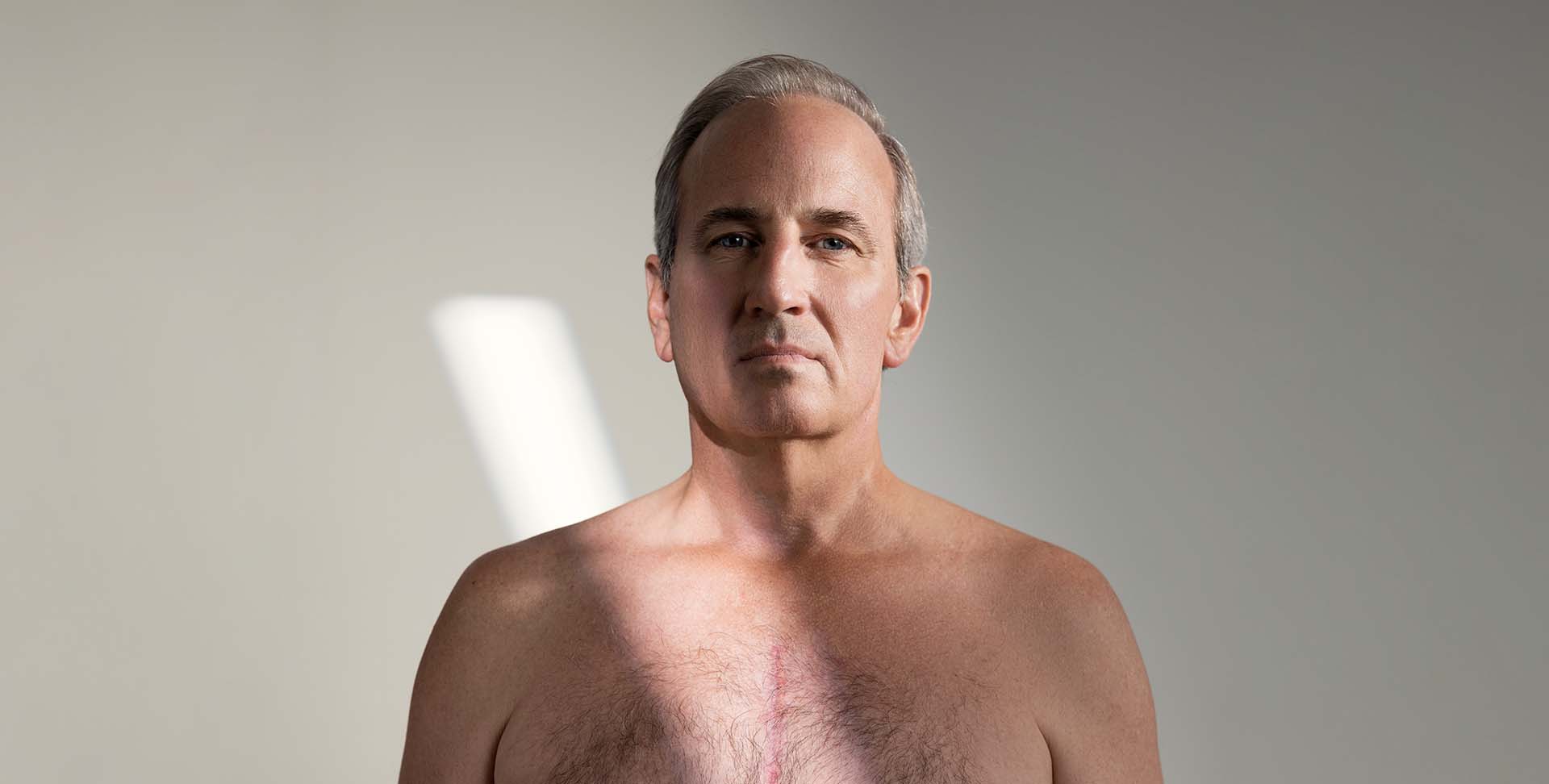 Paul King, showing his incision scar from his heart surgery. 