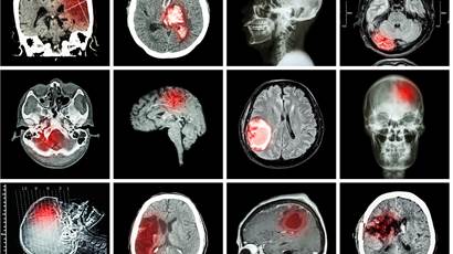Collection of brain disease