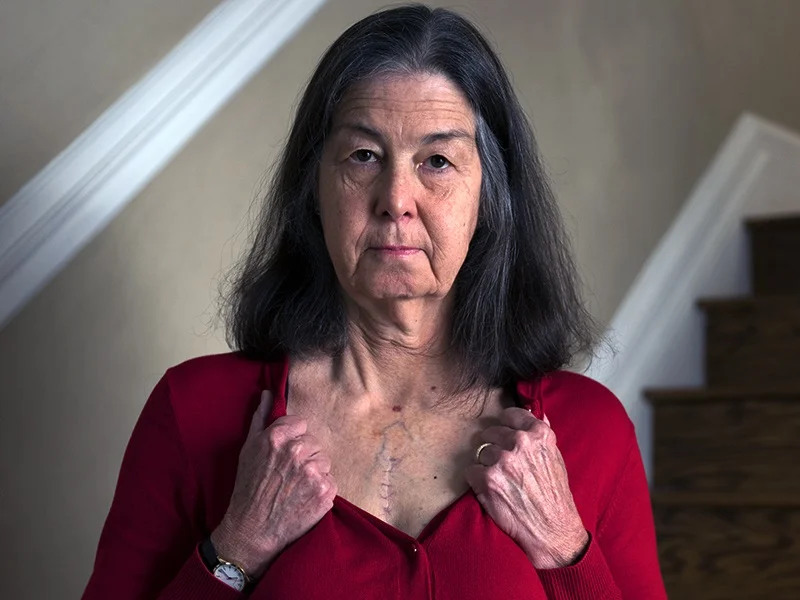 Heart disease survivor Donna Hart showing her surgery's incision scar on her chest