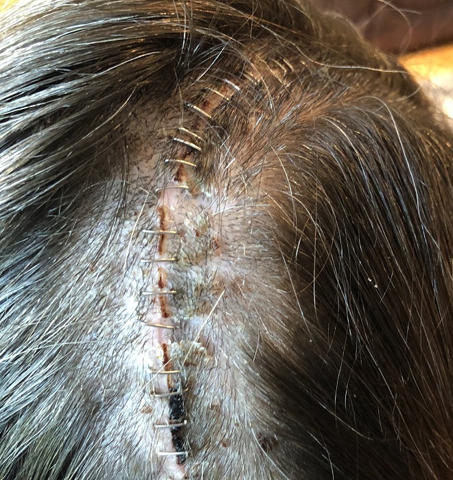 Top view of Courtney’s scalp, showing stitches from her surgery.