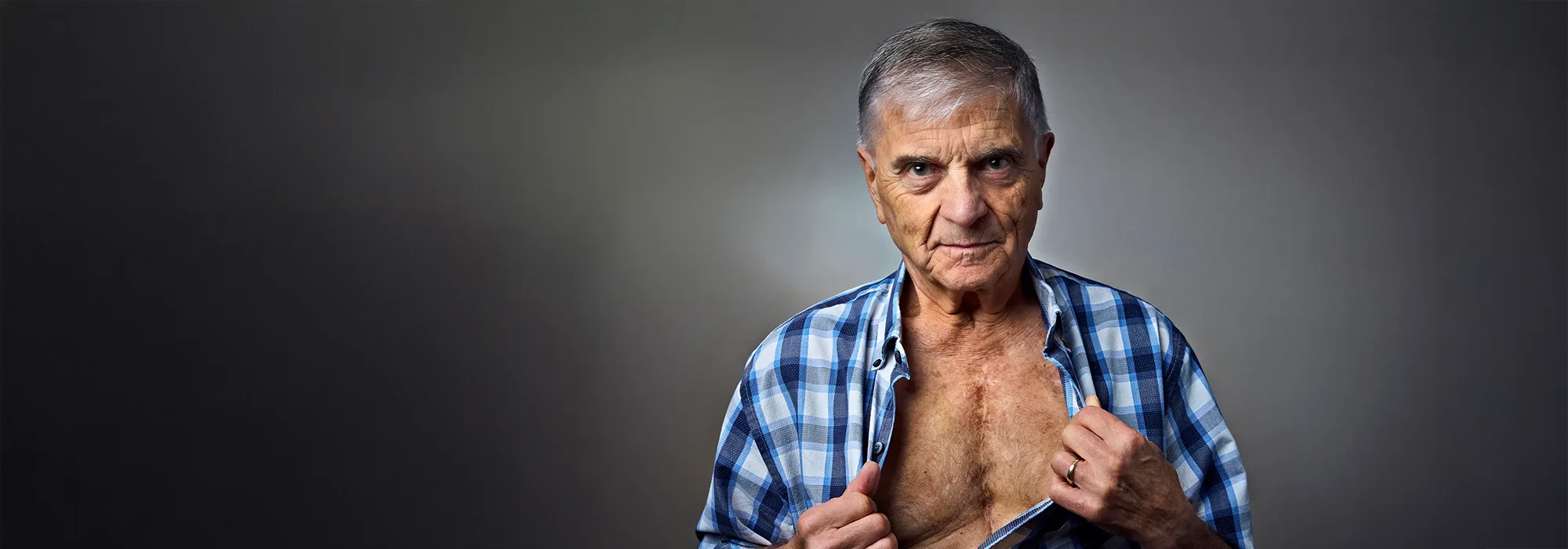 John Wheatcroft, living with congenital heart disease, shows the surgery scar on his chest.