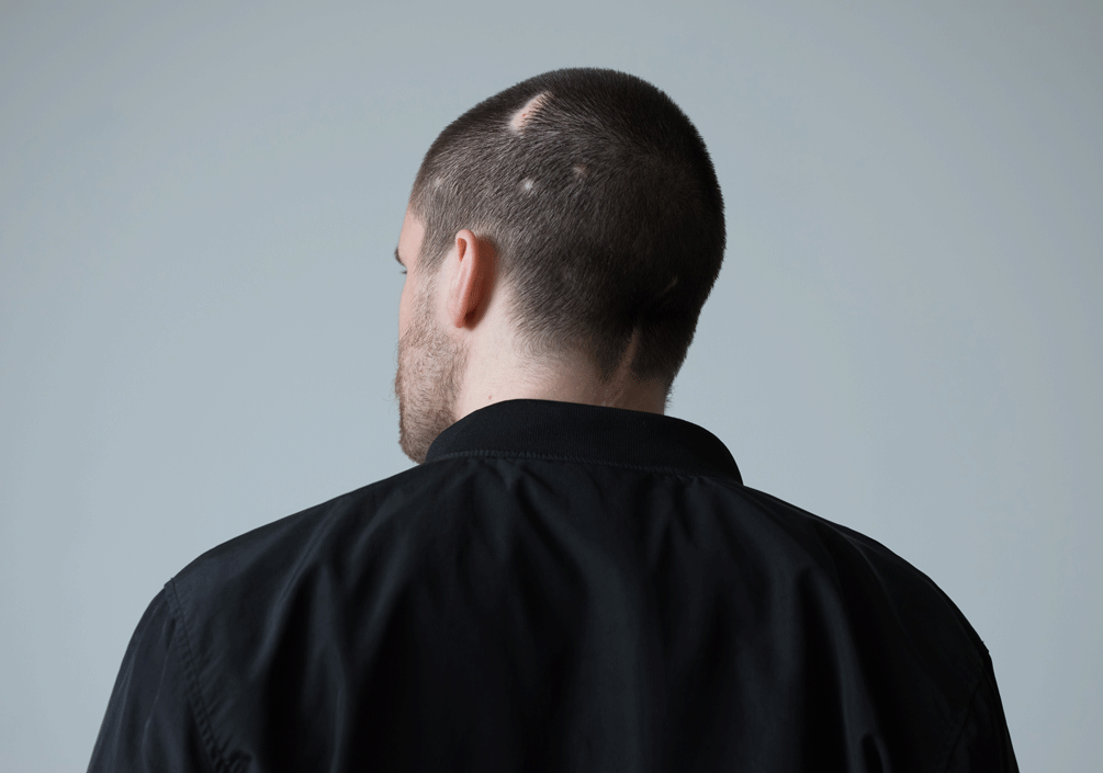 Justin carries the scars of two brain surgeries