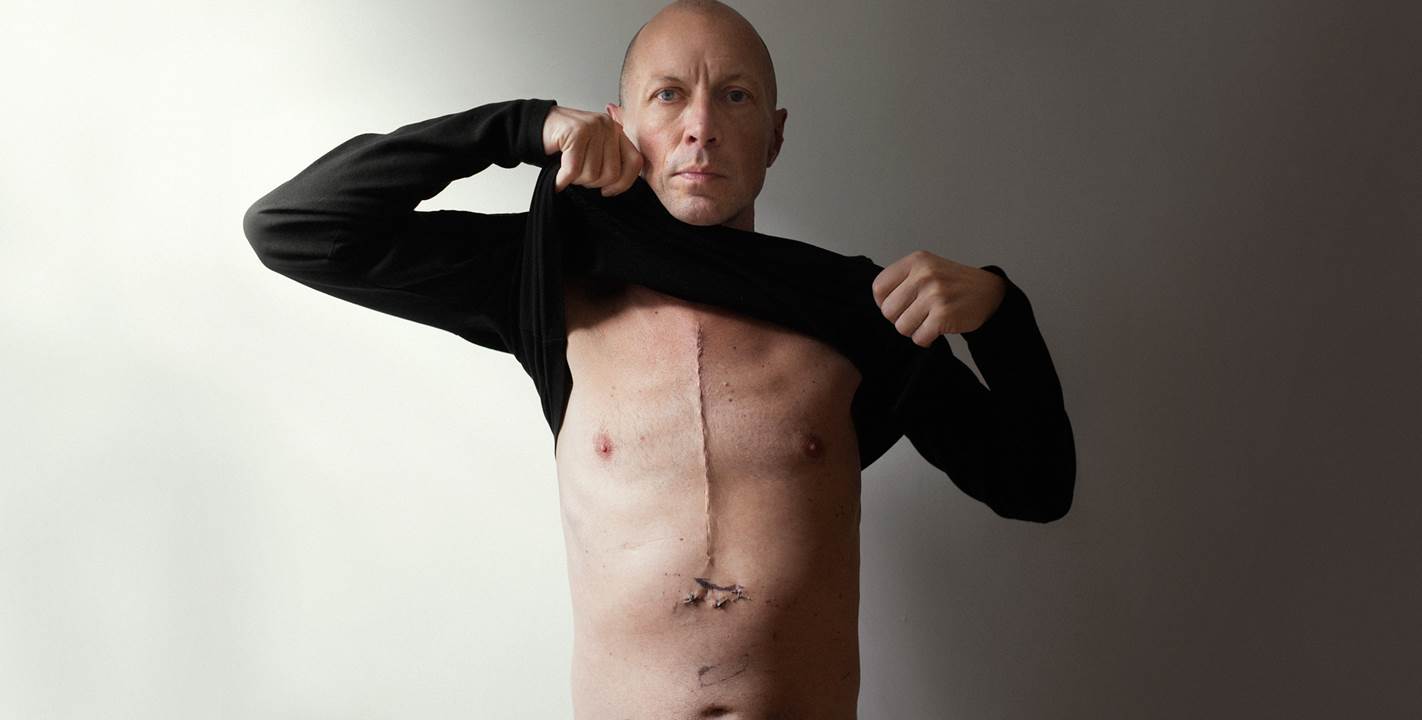 Maciej Toporowicz shows his scar from open heart surgery.