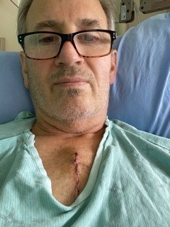 Paul King in a hospital gown showing an incision on his chest from open heart surgery.