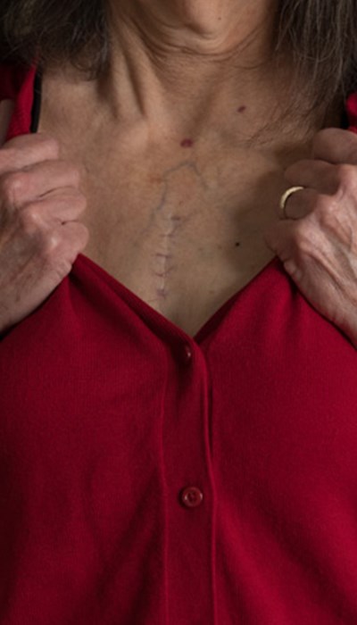 Close up of heart transplant surgery scar