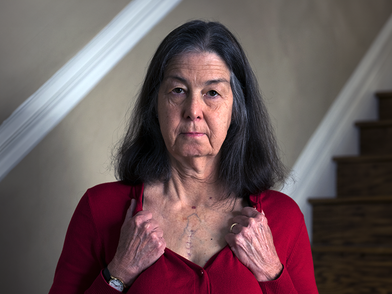 Heart disease survivor Donna Hart showing her surgery's incision scar on her chest