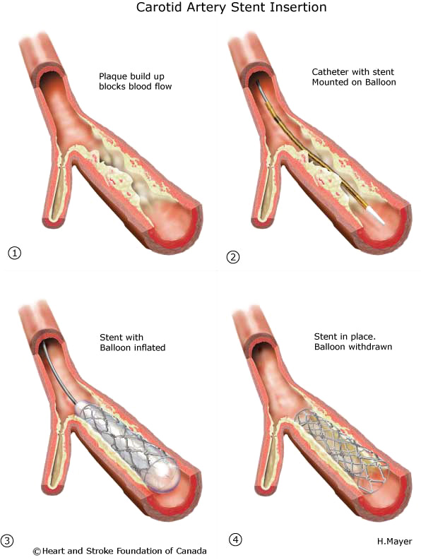 Carotid Artery Stent Insertion